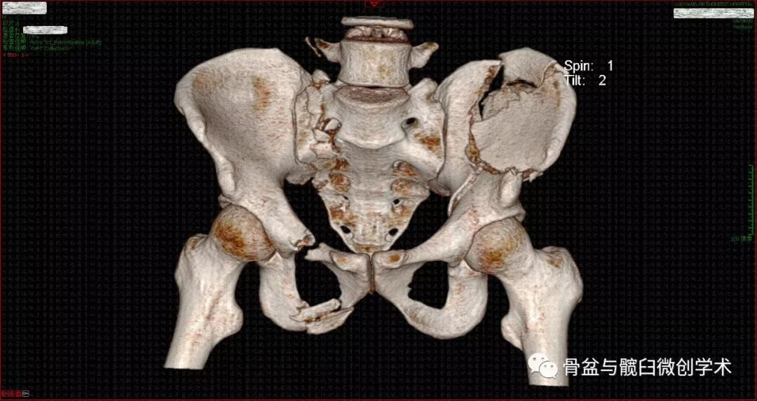髂前上棘骨折图片