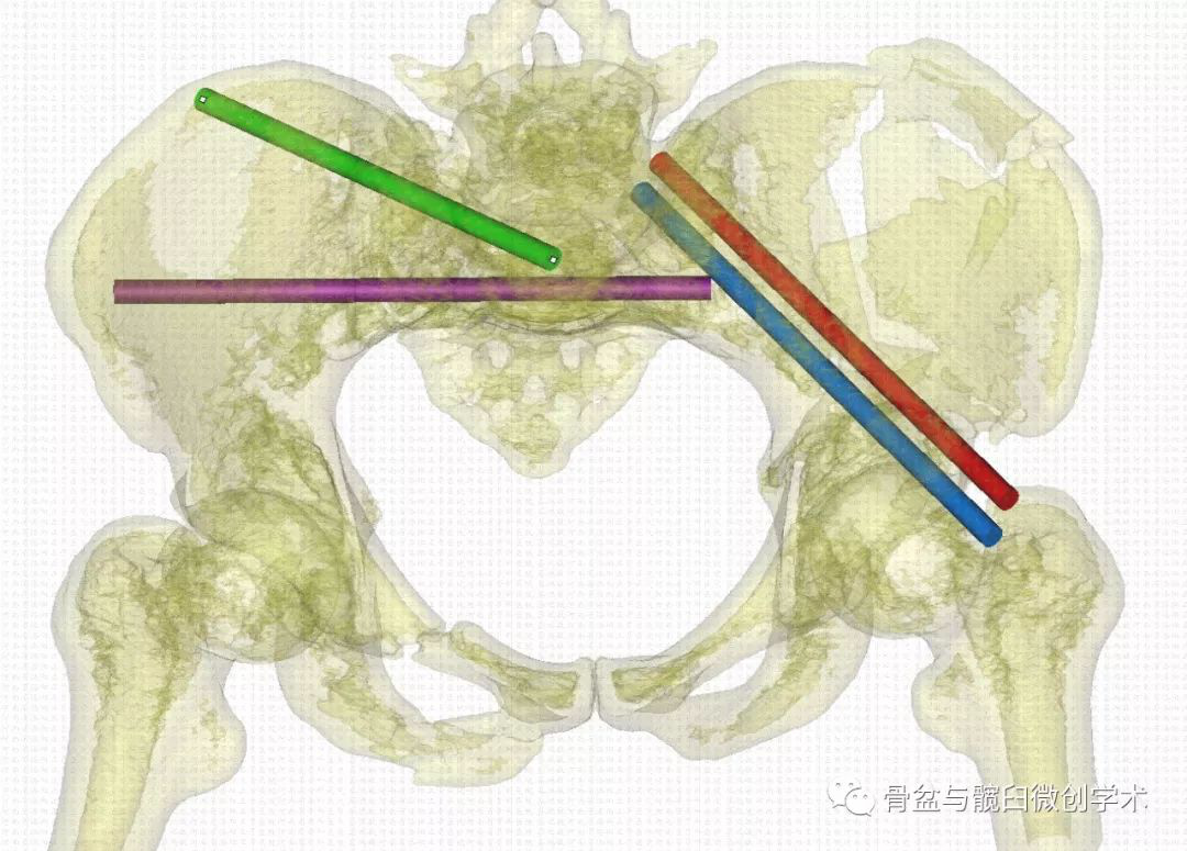 入口位像上的指向lc-ii螺钉在左侧髂骨斜位像上的指向这些都可以重复