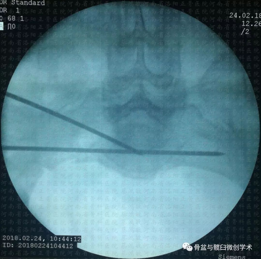 ota61b33型骨盆骨折的微創手術治療