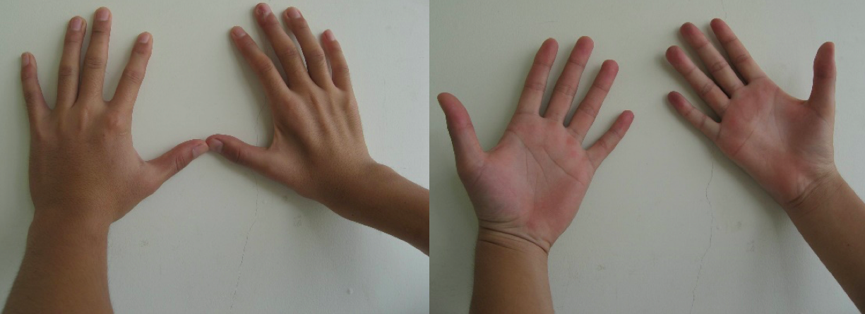 手掌肌肉萎缩早期图片图片