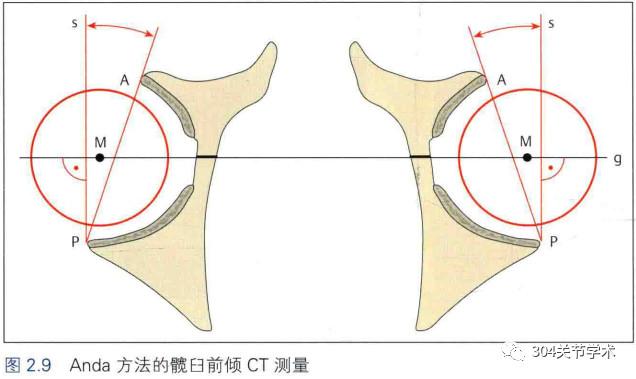 股骨颈前倾角测量图片图片