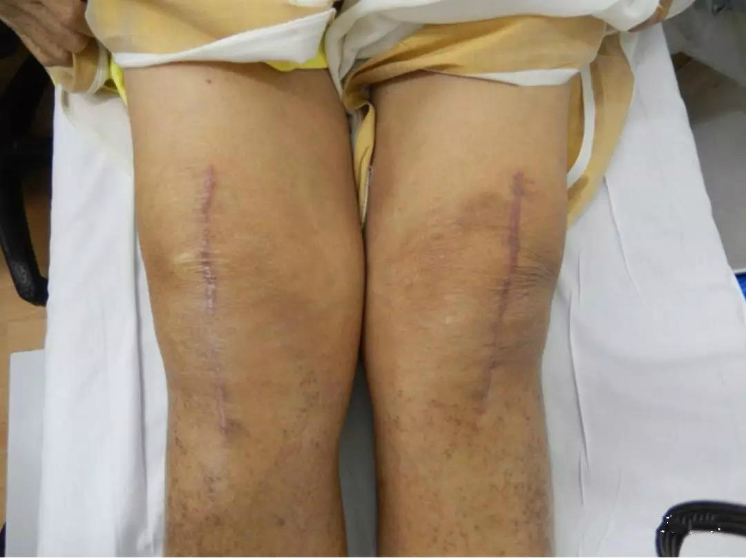 隐藏式美容缝合在全膝关节置换术中的应用伤口外观及患者满意度的前瞻