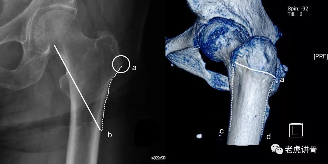 股骨近端骨折:合并外侧壁骨折,内固定要小心