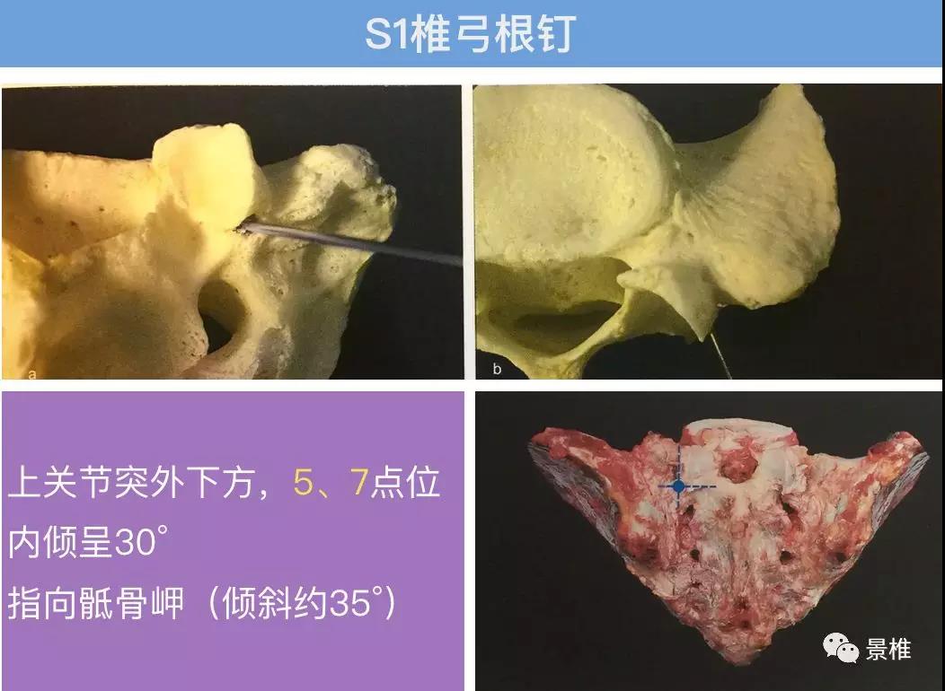 腰椎椎弓根钉置入方法