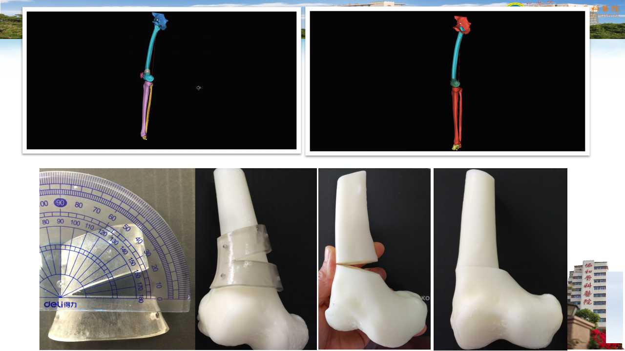 3d導板輔助股骨髁上截骨治療膝外翻畸形