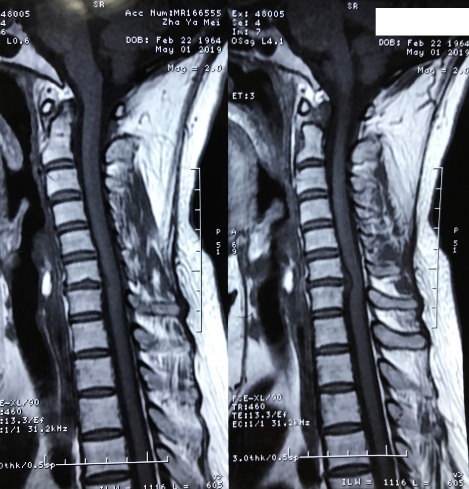 颈椎mri t2相横截面扫描提示颈6-7椎间盘突出,进入椎管,压迫硬膜囊.