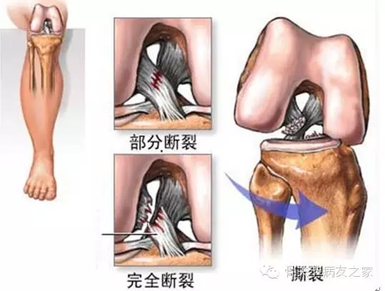 膝關節是人體最複雜的關節,由股骨