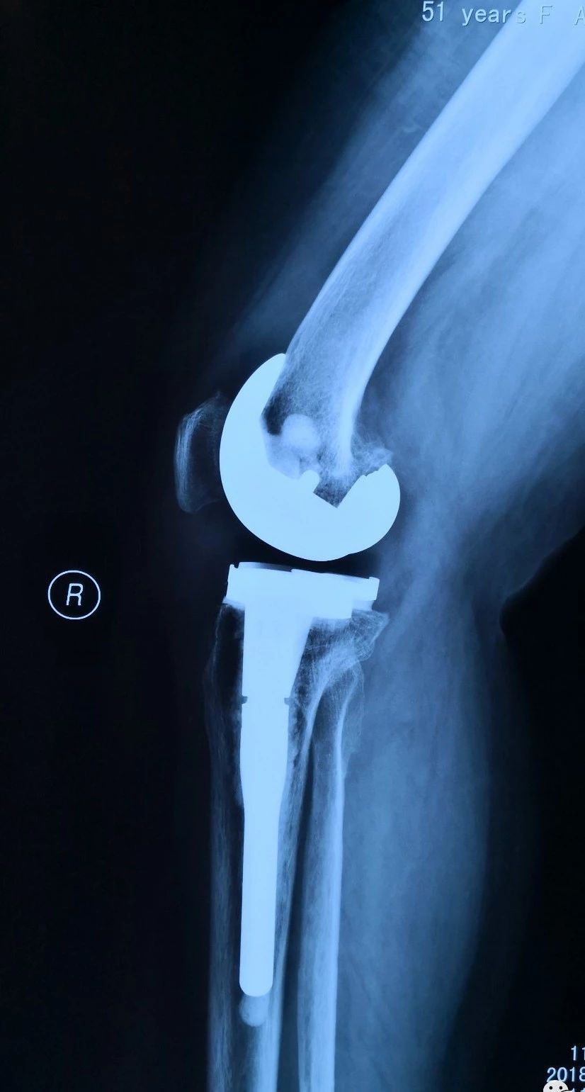 变形的腿变直不疼了