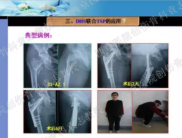 学术分享动力髋钉板dhs联合保护钢板tsp治疗股骨转子间骨折
