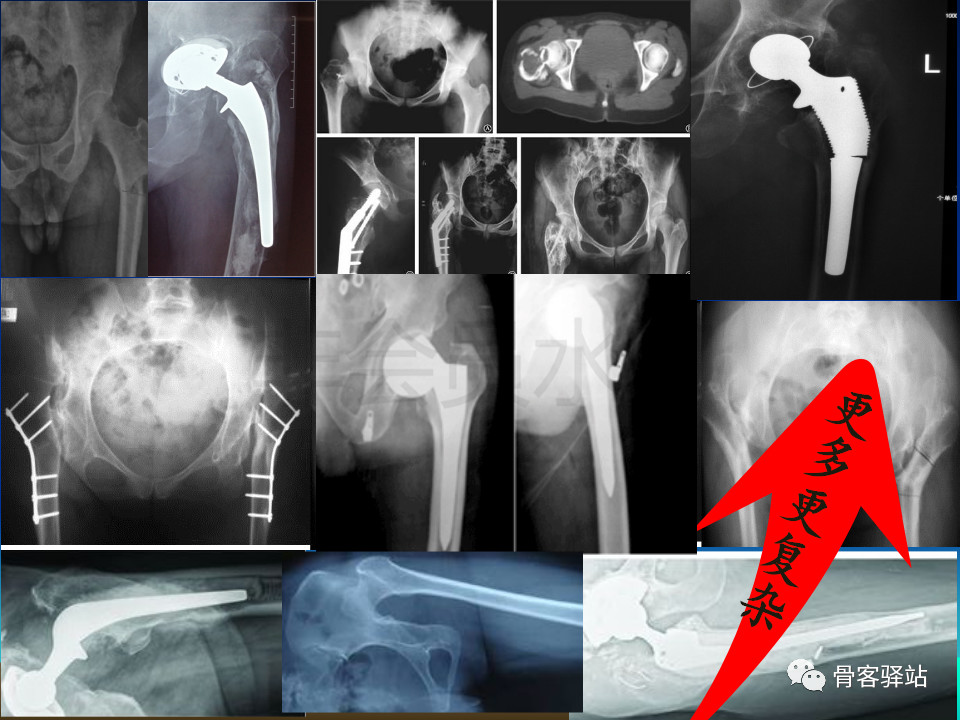 大转子延长截骨股骨近端畸形髋重建必备技能