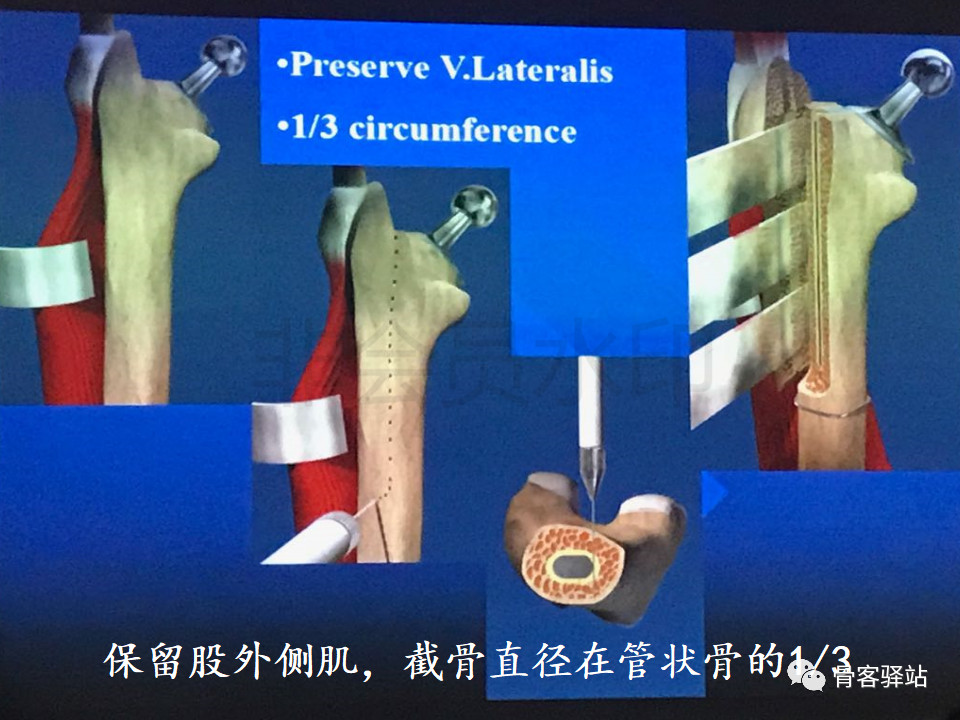 大转子延长截骨股骨近端畸形髋重建必备技能
