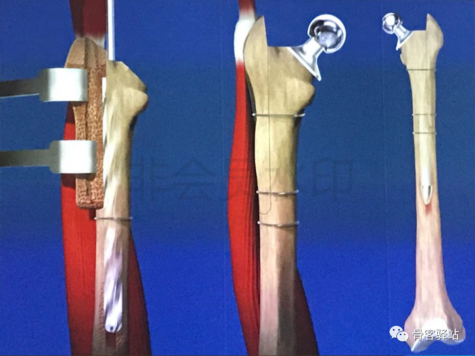 大转子延长截骨股骨近端畸形髋重建必备技能