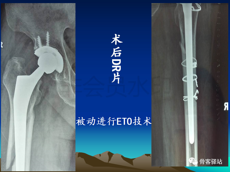 大转子延长截骨股骨近端畸形髋重建必备技能