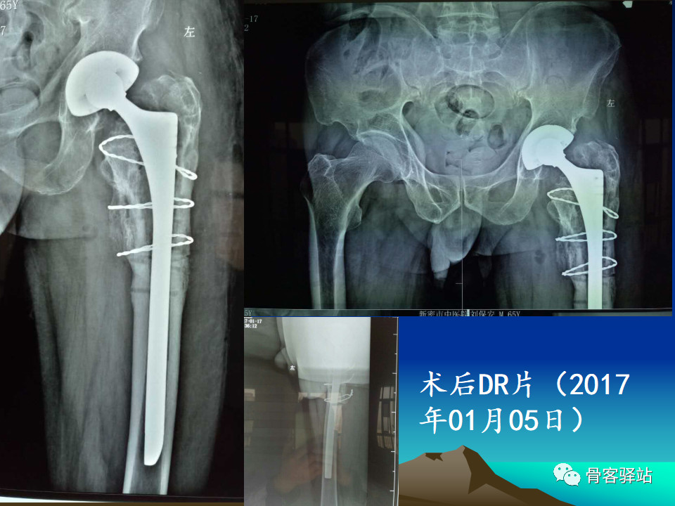 大转子延长截骨股骨近端畸形髋重建必备技能