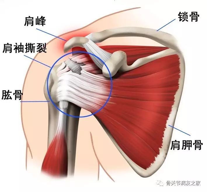 肩胛下肌和小圆肌四块肌肉和肌腱),这些肌肉的运动维持着肩关节的稳定