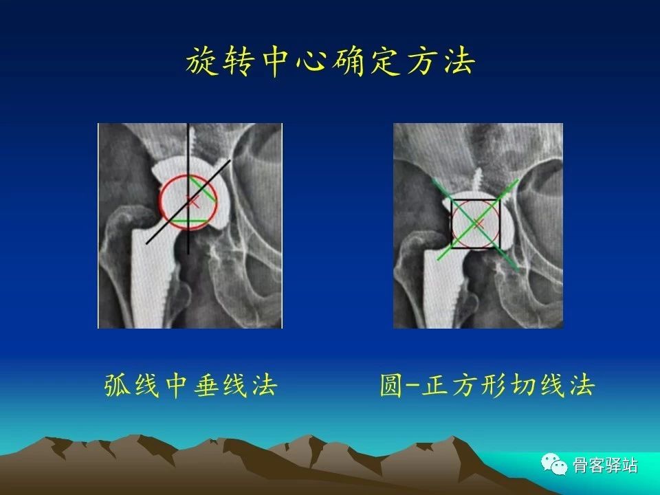 髋关节置换系列三术后x线评估