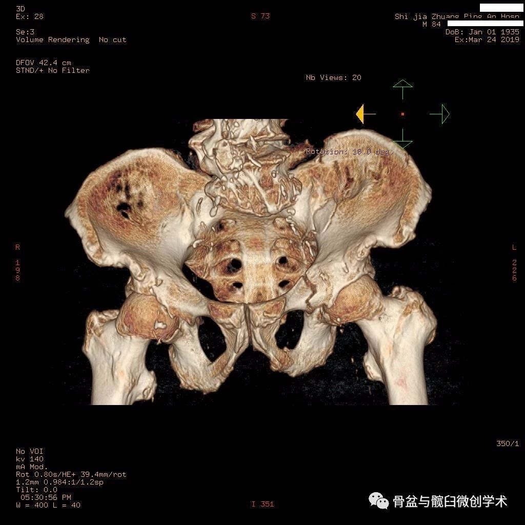 兄弟攜手共進,醫患美好共築——一例老年骨盆骨折病