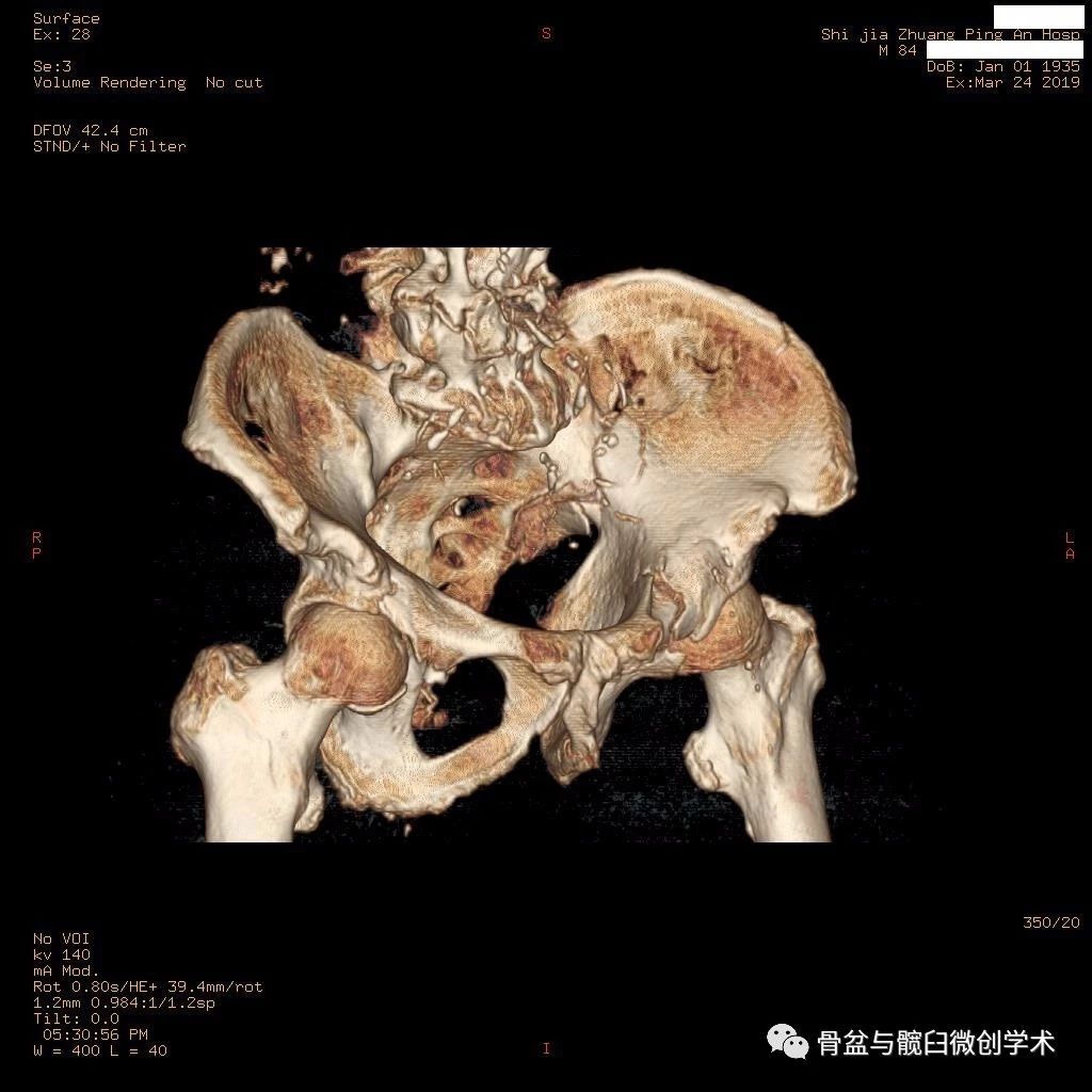 骨盆ct骨盆正位x線2.左側髂骨新月形骨折.1.