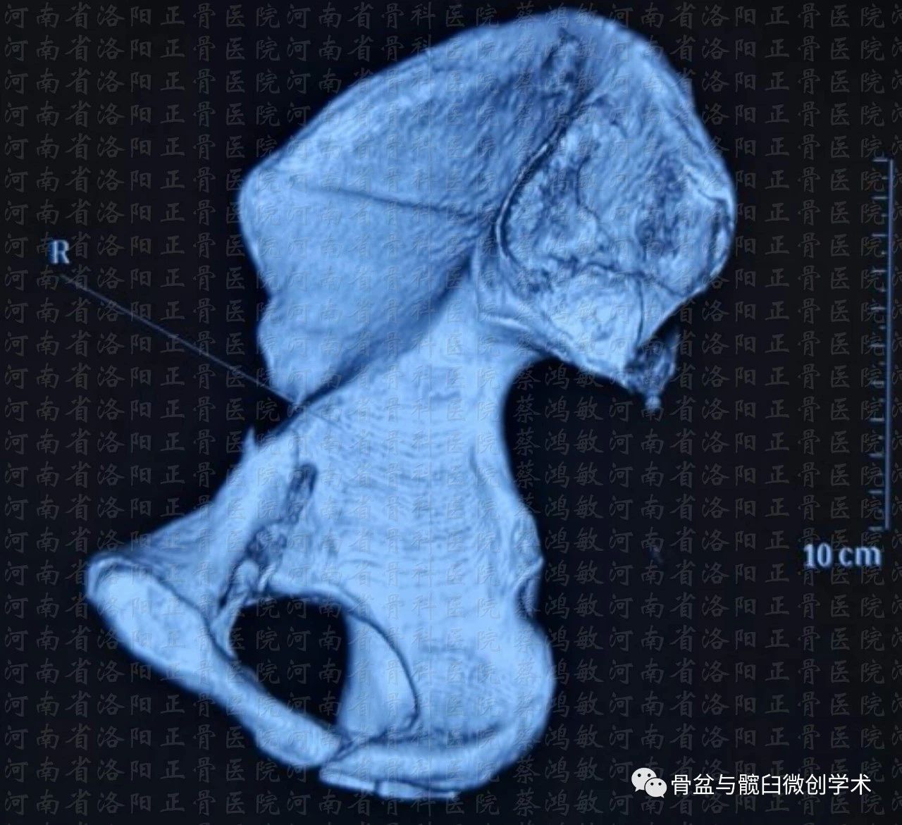 ota61c13型骨盆骨折合併ota62b31型髖臼骨折的微創治療骶髂螺釘前柱