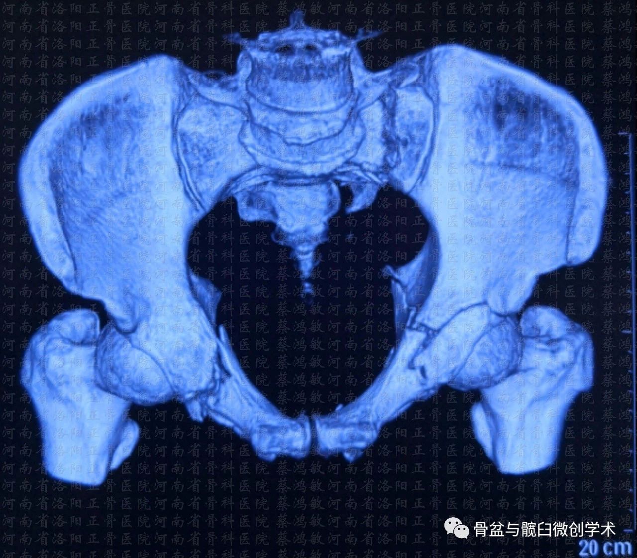 ota61c13型骨盆骨折合併ota62b31型髖臼骨折的微創治療骶髂螺釘前柱