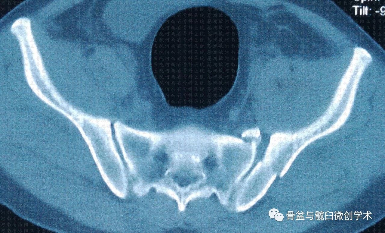 經髂骨骶骨的骶髂關節骨折脫位的微創治療骶髂螺釘lcii螺釘恥骨上支