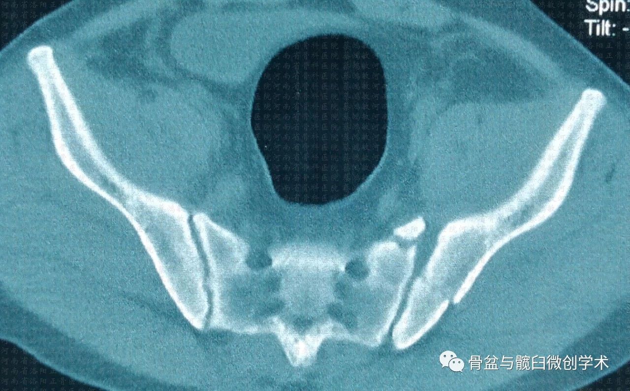 經髂骨骶骨的骶髂關節骨折脫位的微創治療骶髂螺釘lcii螺釘恥骨上支