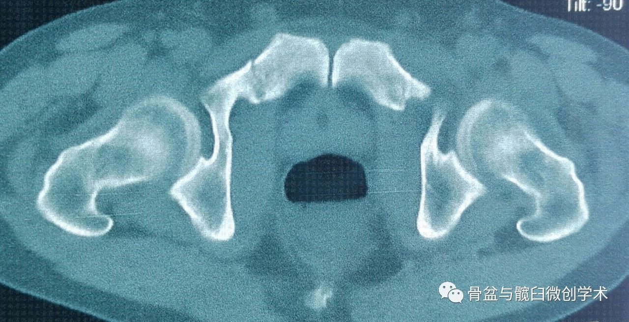 經髂骨骶骨的骶髂關節骨折脫位的微創治療骶髂螺釘lcii螺釘恥骨上支