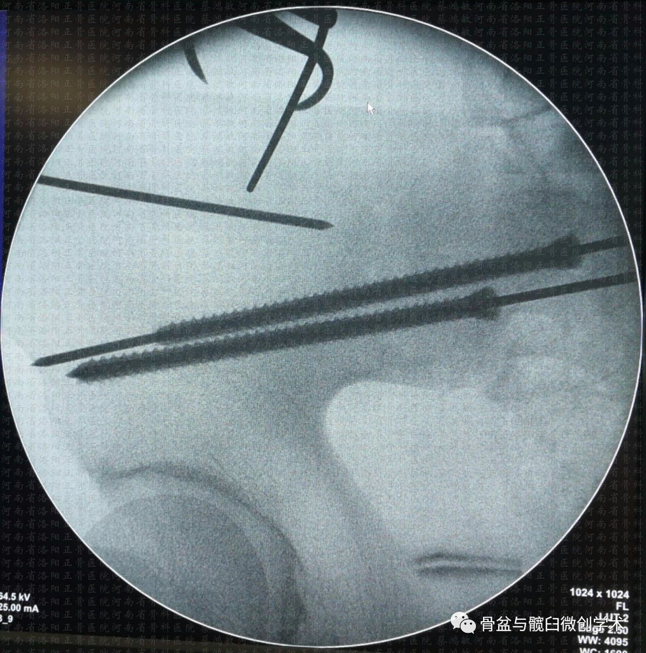 經髂骨骶骨的骶髂關節骨折脫位的微創治療骶髂螺釘lcii螺釘恥骨上支