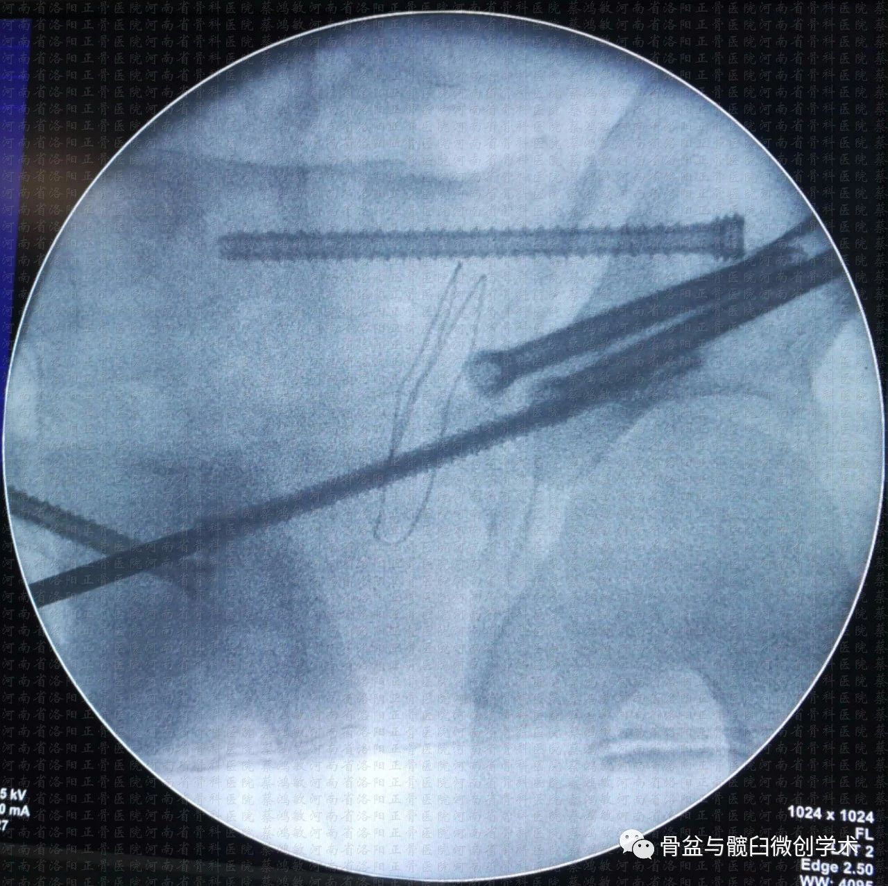 经髂骨骶骨的骶髂关节骨折脱位的微创治疗骶髂螺钉lcii螺钉耻骨上支