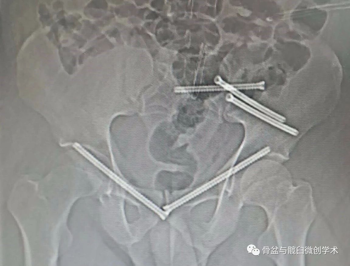 骶髂螺钉进针点图片