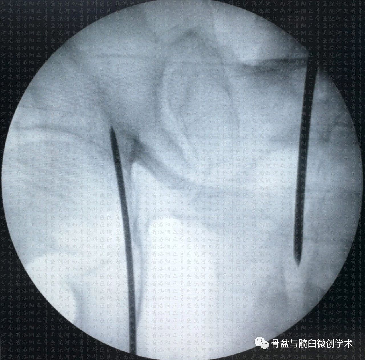 髖臼橫形骨折的微創治療經皮前柱後柱螺釘置入手術