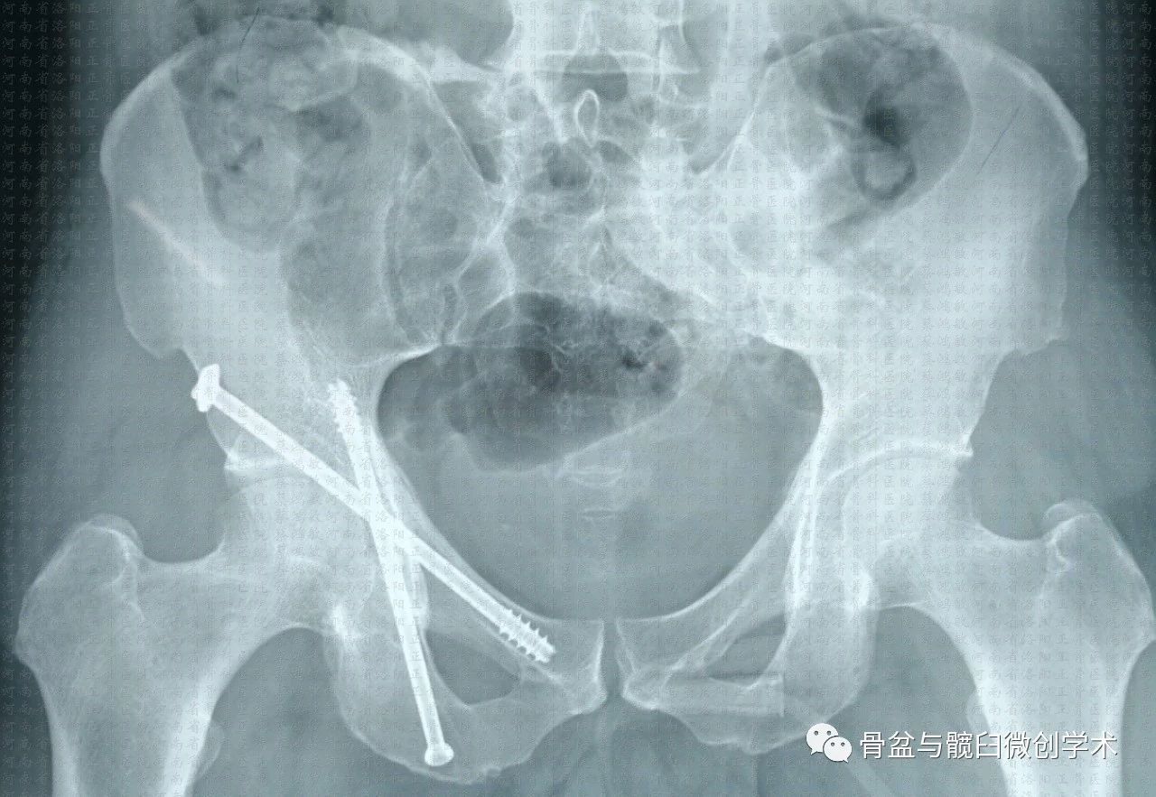 髖臼橫形骨折的微創治療經皮前柱後柱螺釘置入手術