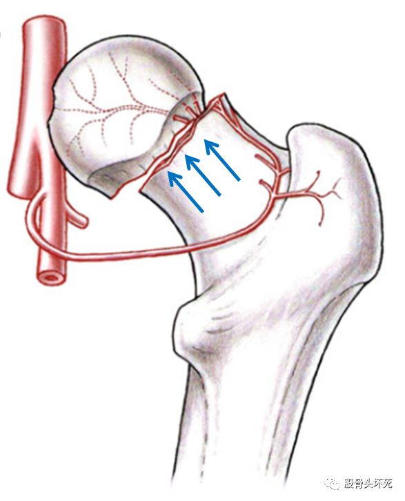 (上图为股骨颈骨折后血管受损的示意图,由孙伟,杨雨润医生提供)如何