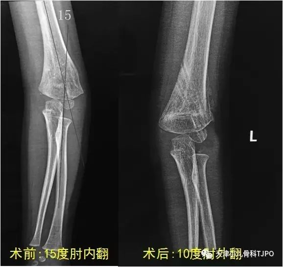 已有人評分標籤肩肘肘內翻畸形肘關節全部評論最舊最新暫無評論,快