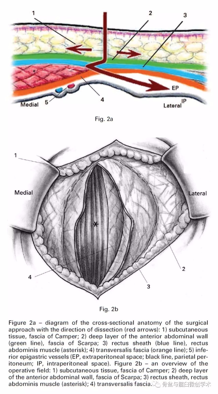 同时保护好髂腹股沟神经(ilioinguinal nerve),股神经(femoral nerve)