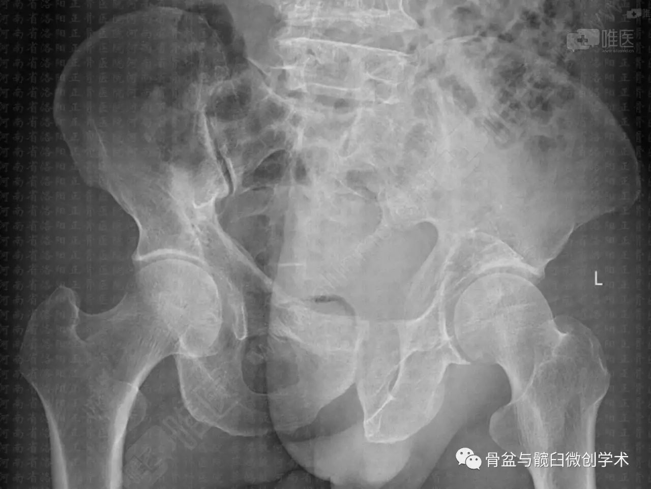 特殊类型髋臼骨折的治疗