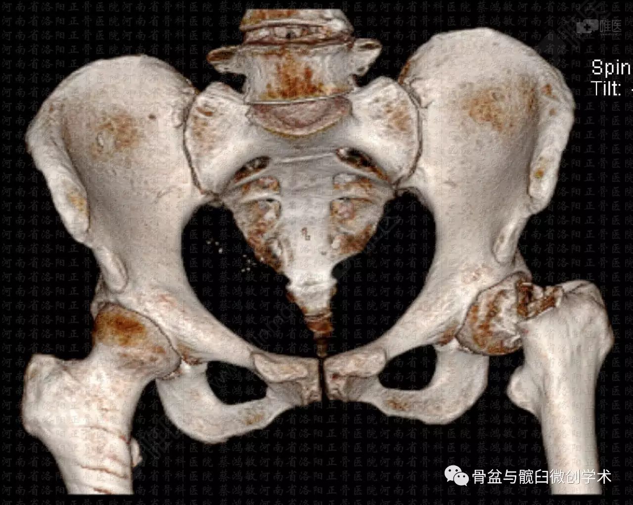 青壮年股骨颈头下型骨折的治疗空心钉股骨矩buttress钢板