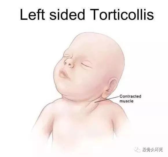 歪脖子病