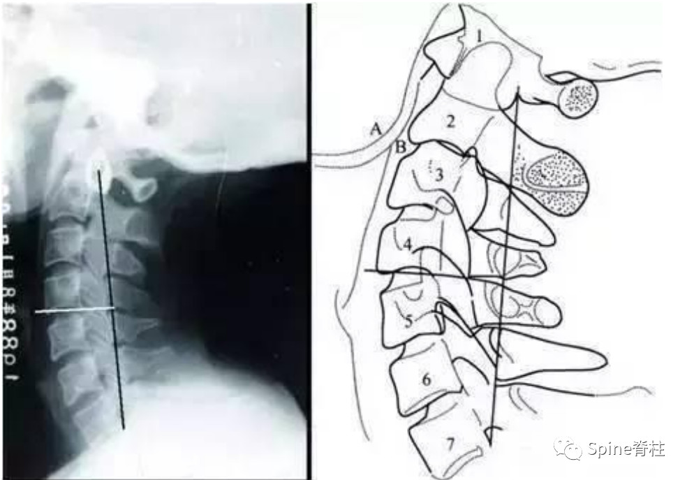 颈椎侧位片解剖图片