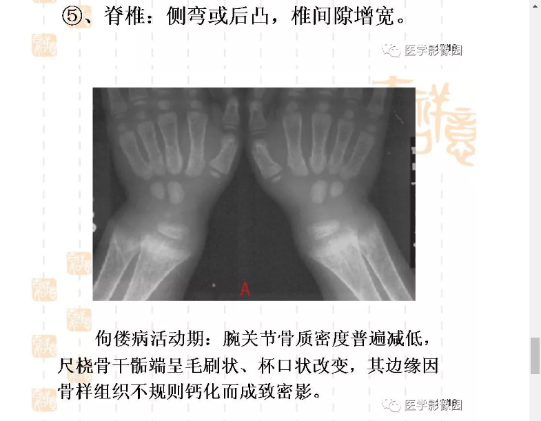 佝偻病的影像学特点有哪些?
