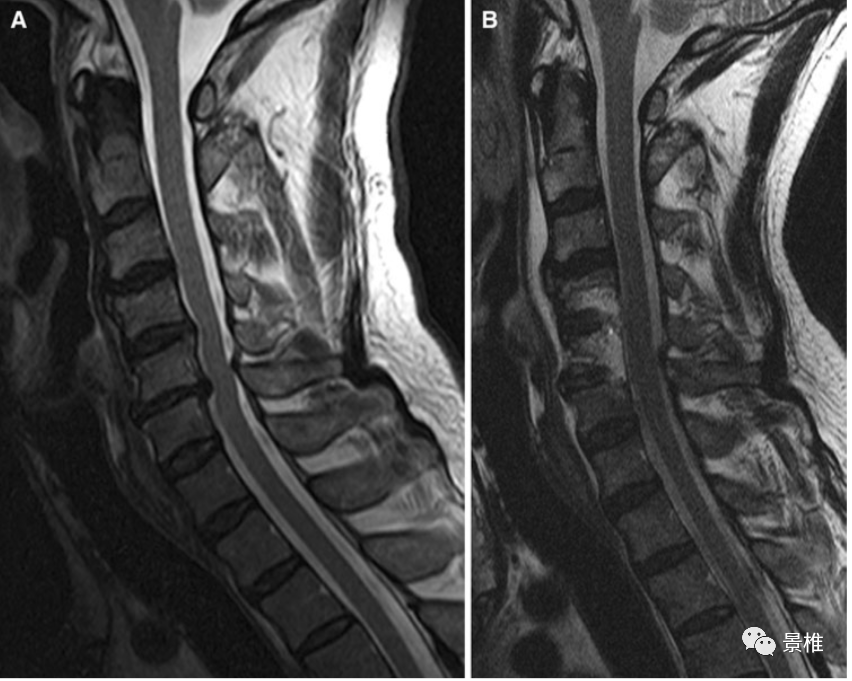 但要知道,有21%的颈髓受压患者不会有典型的脊髓损害表现.