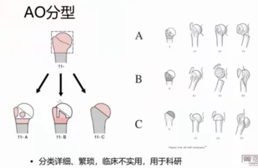 neer分型,neer分型四个分型图,股骨颈骨折分型(第3页)_大山谷图库