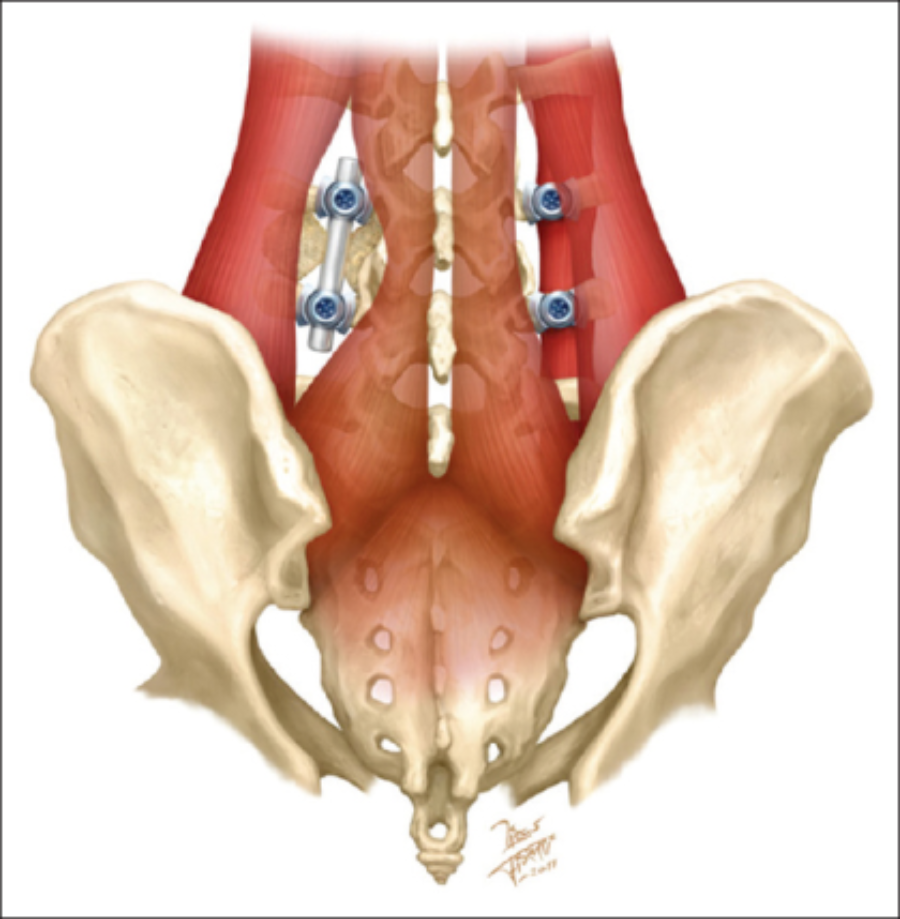 mis-tlif手术示意图