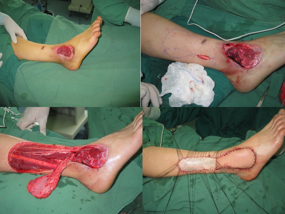 足踝部皮肤缺损皮瓣术式的选择