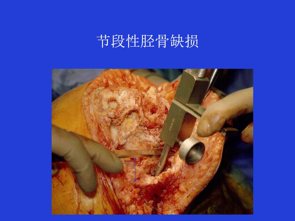 我是如何处理胫骨近端骨缺损的