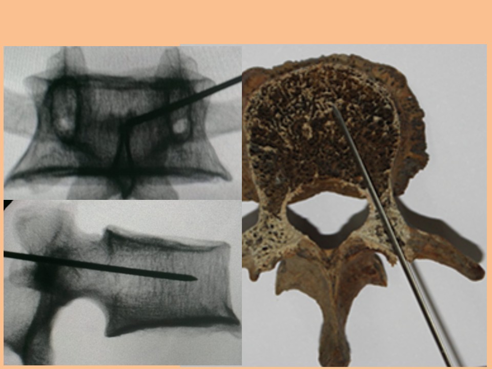 单侧穿刺椎体成形术的解剖学与影像学研究