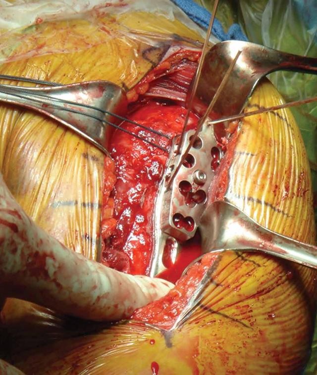 综述锁定钢板治疗肱骨近端骨折的5点建议