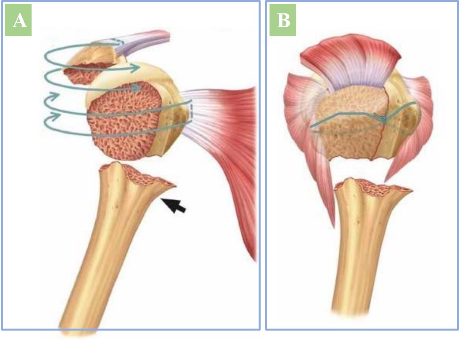 综述:锁定钢板治疗肱骨近端骨折的 5 点建议 -医学文章-唯医,allinmd