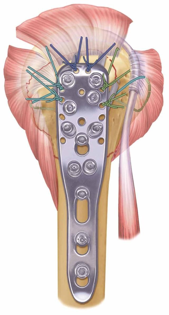 通过连接肩袖肌腱和钢板将肩袖对肱骨近端产生的内翻牵引力进行